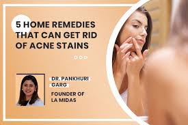 remove acne scars 5 powerful home remes