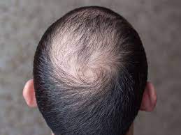 Treating hair loss from these fungal infections requires a different approach than with other types of ringworm of the scalp is a fungal infection that affects the scalp and hair fibers, causing hair loss. Hair Loss Caused By Infections The Toronto Hair Transplant Clinic