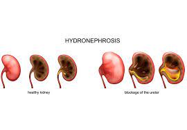 hydronephrosis uci pediatric urology