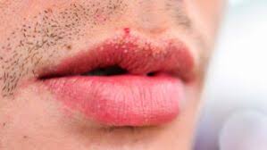 white ps on lips 5 potential causes
