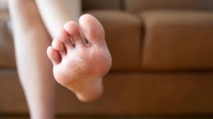 what does athlete s foot look like