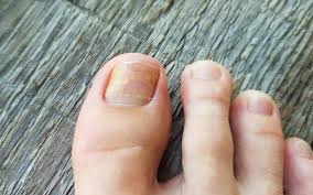 toenail fungus a common problem with