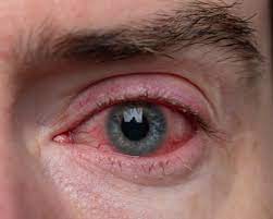 what causes bloodshot eyes vision