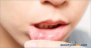 canker sores and anxiety