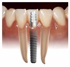 Dental implant graphic