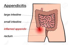 Appendicitis Inflamed Appendix Labeled Chart With Large And