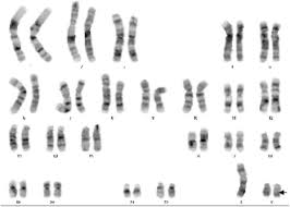 Maybe you would like to learn more about one of these? A Patient With 46 Xy 47 Xyy Karyotype And Female Phenotype A Case Report Bmc Endocrine Disorders Full Text