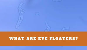 eye floaters what are they and when