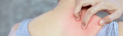 sweat allergy causes and symptoms