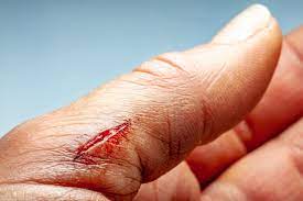 Zakażenie rany – jak wygląda? Prawidłowe gojenie się rany. Konsekwencje  zakażenia i jak do niego nie dopuścić? | Strona Zdrowia