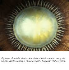 Crystalline Lens And Cataract By Joah F Aliancy And Nick
