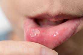 cold sores vs canker sores and gluten