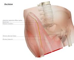hip anterior approach smith petersen