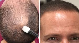 dermmatch hair loss concealer great