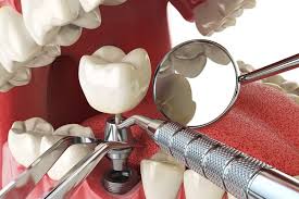 علاج زرع الاسنان - طبيب أسنان مانافجات الجانب