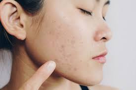 how to remove acne scars care