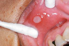 ulcerative lesions of the mucosa