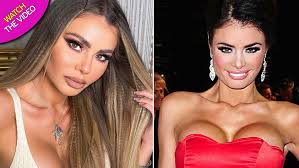 towie s chloe sims removes fillers
