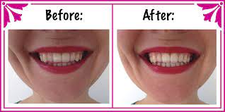 natural teeth whitening treatment