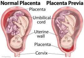 Often the types of placenta previa determine the intensity of bleeding and severity of the condition. Student Nurses What Is Placenta Previa Placenta Previa Facebook