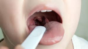 tonsillectomy reduce sore throats