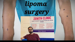 lipoma removal surgery dhaka desh