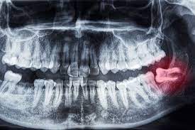 are your wisdom teeth causing you pain