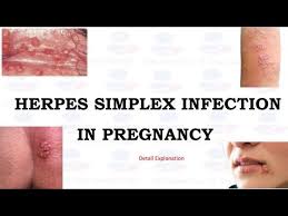 herpes simplex virus infection in