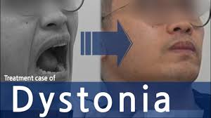 dystonia oromandibular eyes