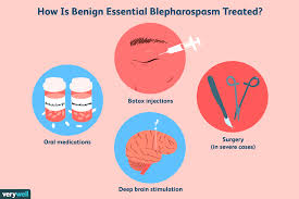 benign essential blepharospasm