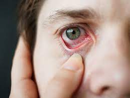 eye allergies demystified anaheim eye