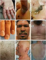 chemotheutics a hand foot syndrome