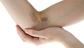 how to get rid of bruises definitive