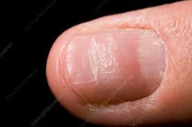 fingernail pitting due to eczema