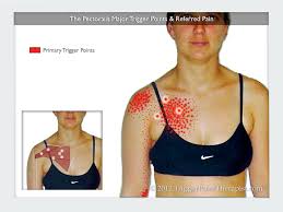 pectis major trigger points the