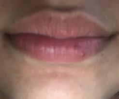 what is this tiny red p on my lip