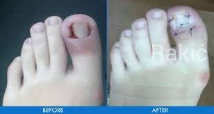 ingrown toenail reconstructive