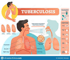 Tuberculosis (tb) is a contagious infection that usually attacks your lungs. Tuberculosis Deadliest Infection Of The 21st Century So Far Saudi Gazette
