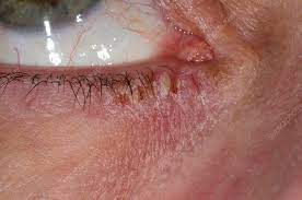 eczema around the eye stock image