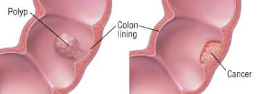 Image result for inside of the lining of the colon
