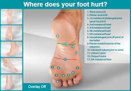 plantar fasciitis causes and