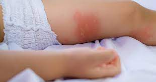 natural remes for diaper rash on