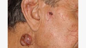 skin cancer on neck appearance and more