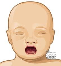 cleft lip and palate in es