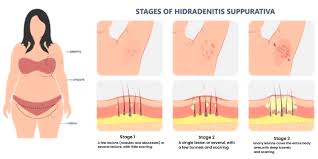 hidradenitis suppurativa find relief
