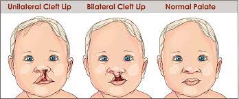 cleft lip or palate repair in thailand