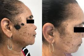 mole removal eternal dermatology