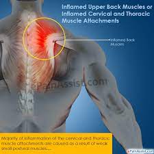 Muscle or ligament strains can occur from repeated use of the muscles, or from improperly or awkwardly lifting heavy objects. Inflamed Upper Back Muscles Treatment Causes Symptoms