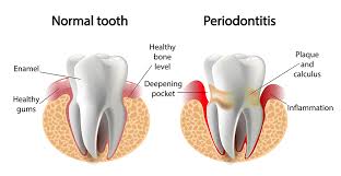 gingivitis vs periodonis what is