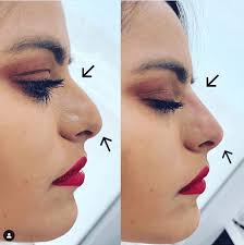 wide nose rhinoplasty nose jobs for